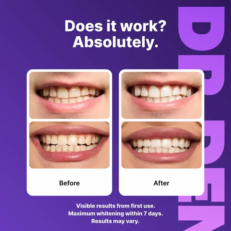 49%OFF ONLY TODAY-Purple Whitening Strips