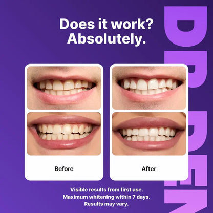 49%OFF ONLY TODAY-Purple Whitening Strips